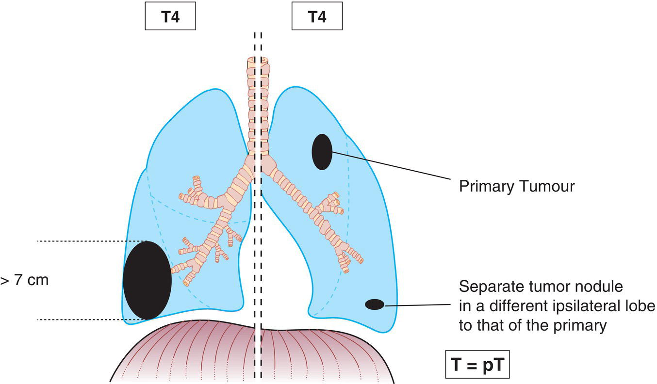 Schematic illustration of tumours more than 7 cm.