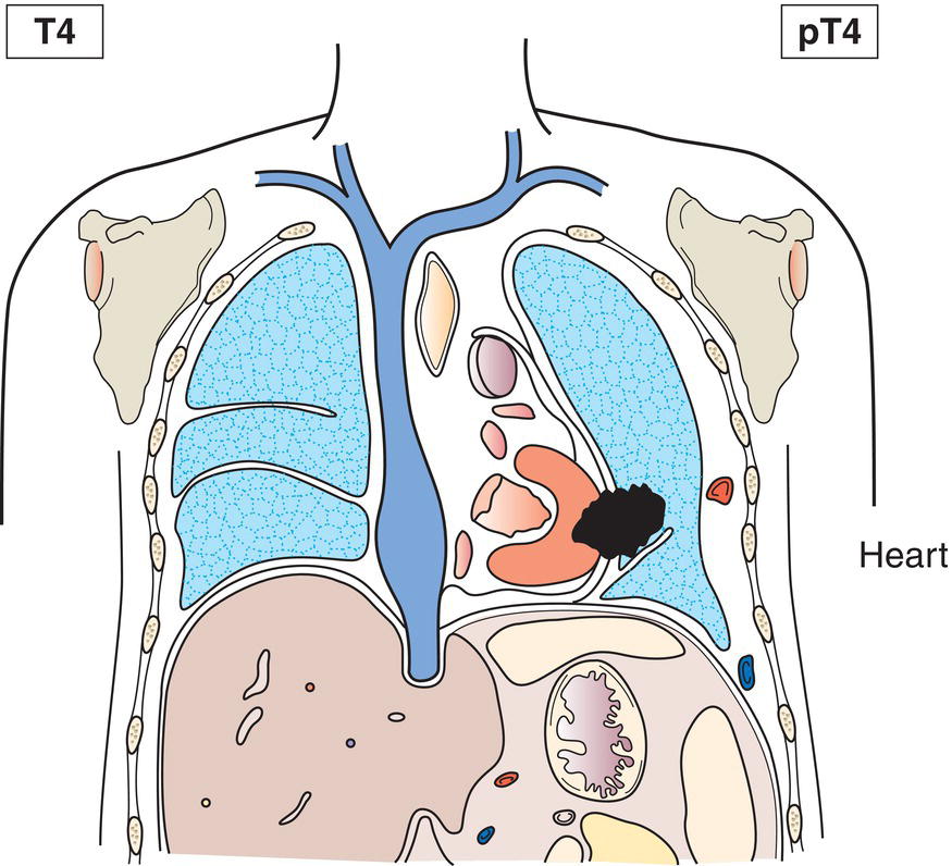 Schematic illustration of mediastinum, heart.