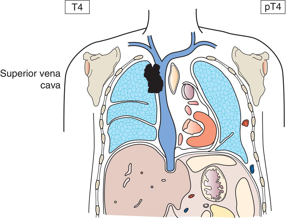 Schematic illustration of great vessels.