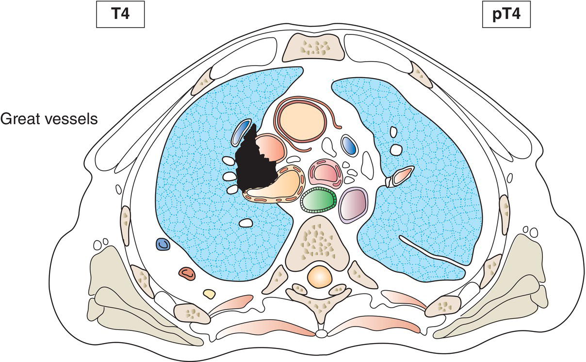 Schematic illustration of great vessels.