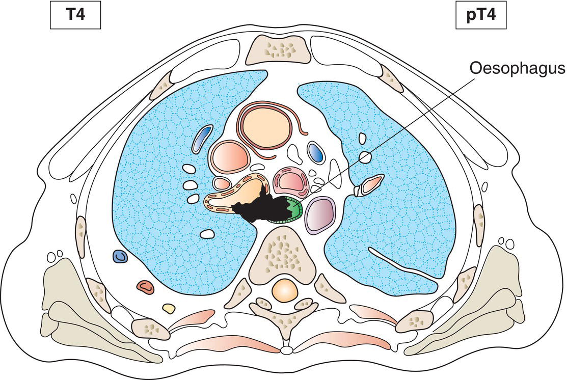 Schematic illustration of trachea, recurrent laryngeal nerve, oesophagus.