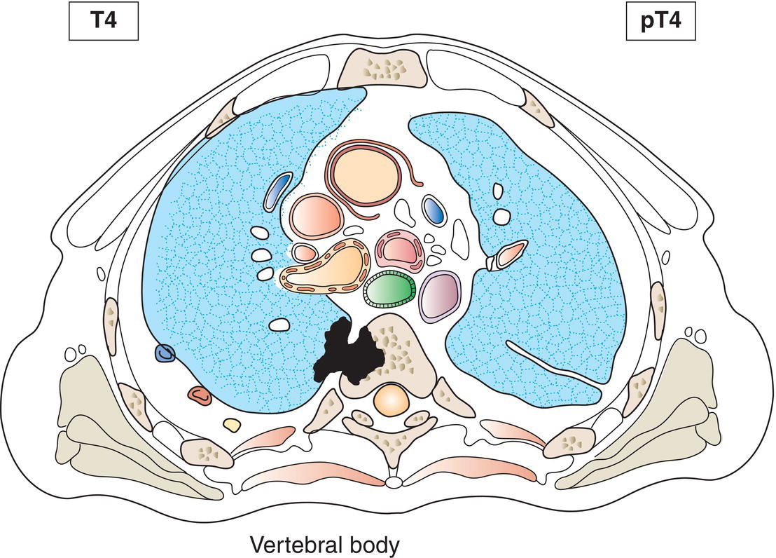 Schematic illustration of vertebral body.