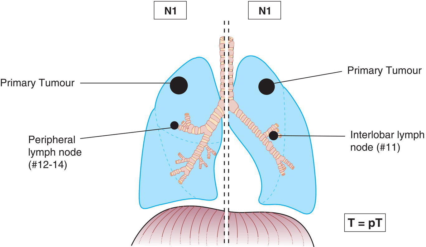 Schematic illustration of Metastasis in ipsilateral peribronchial, ipsilateral interlobar and ipsilateral hilar lymph nodes and Intrapulmonary nodes, including involvement by direct extension.