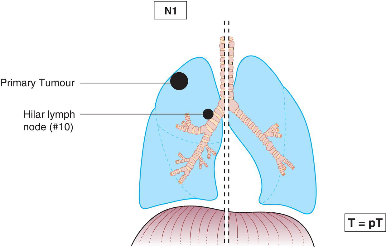 Schematic illustration of Metastasis in ipsilateral peribronchial, ipsilateral interlobar and ipsilateral hilar lymph nodes and Intrapulmonary nodes, including involvement by direct extension.