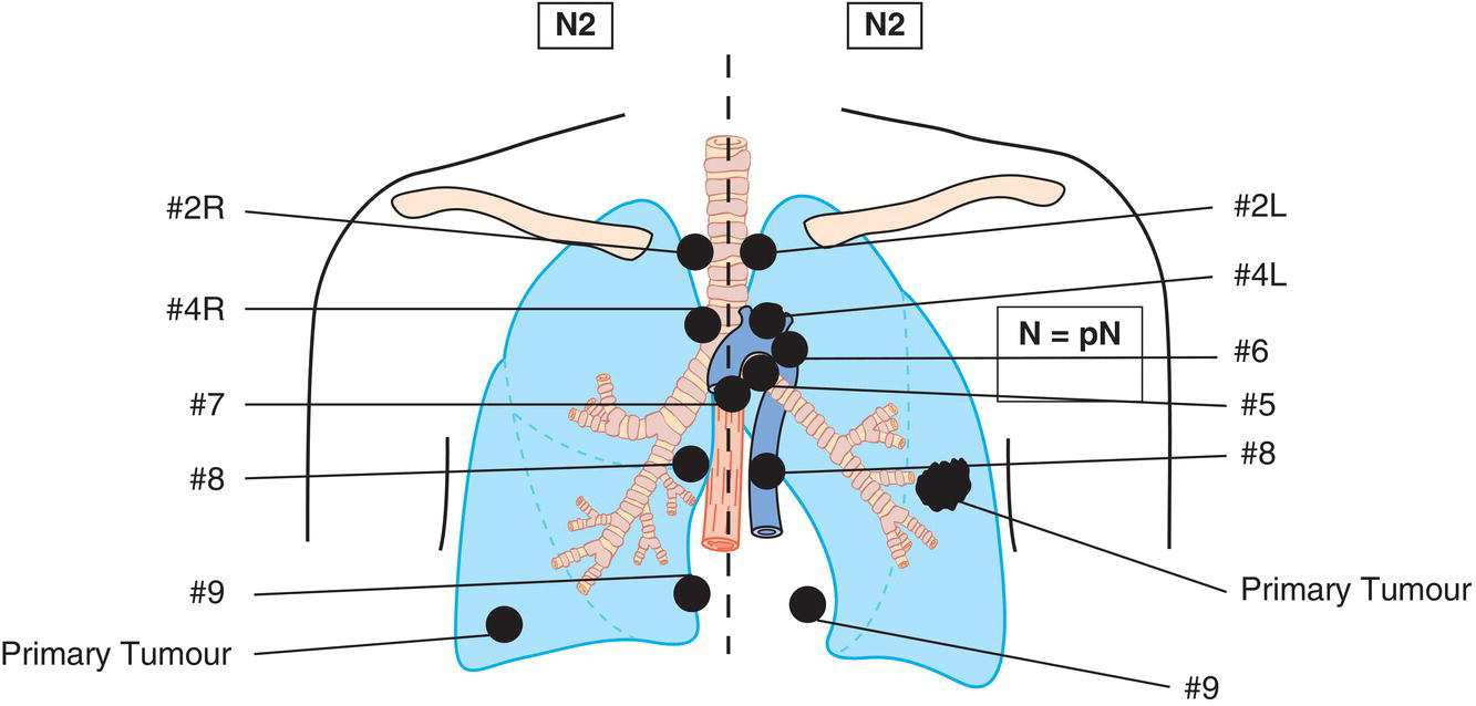 Schematic illustration of Metastasis in ipsilateral mediastinal and subcarinal lymph node.