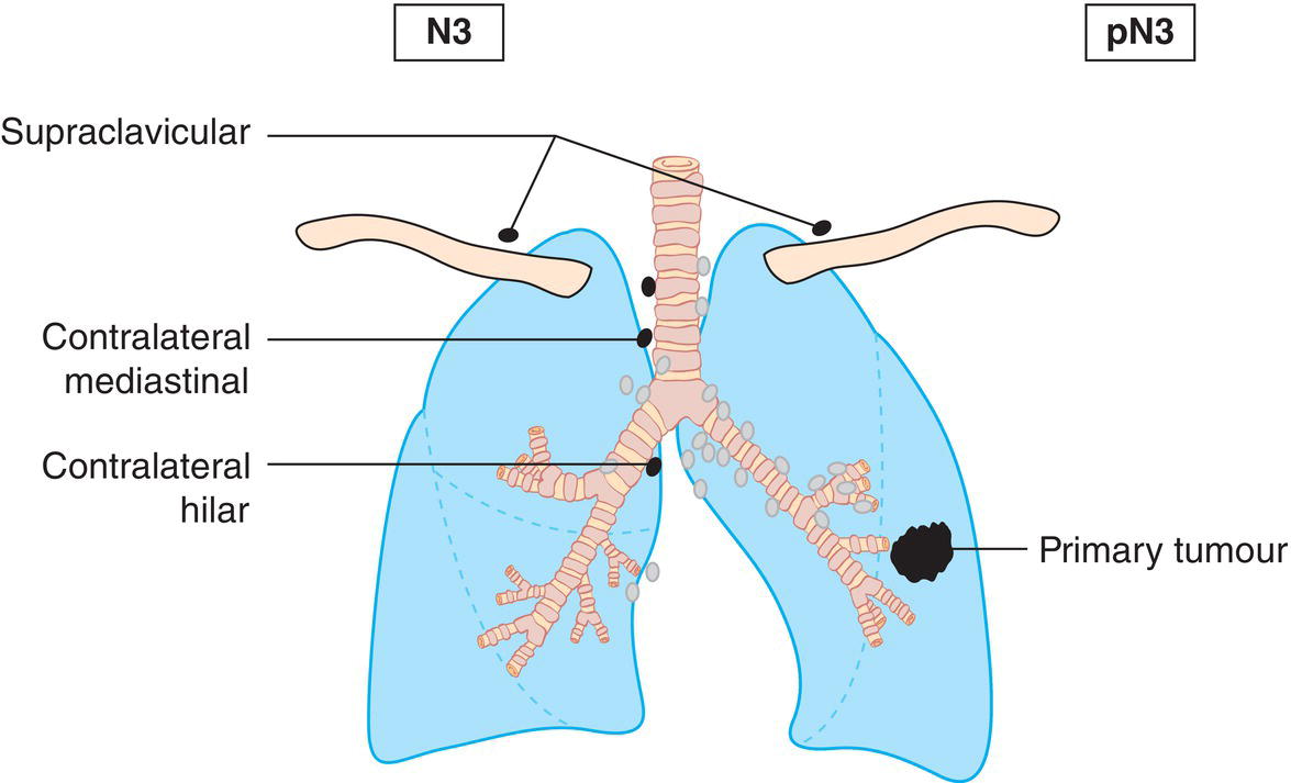 Schematic illustration of Metastasis in contralateral mediastinal, contralateral hilar, ipsilateral or contralateral scalene, or supraclavicular lymph node.