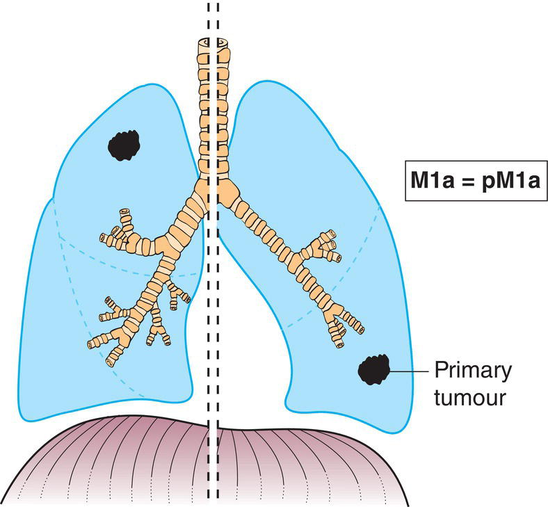 Schematic illustration of Separate tumour nodule(s) in a contralateral lobe.