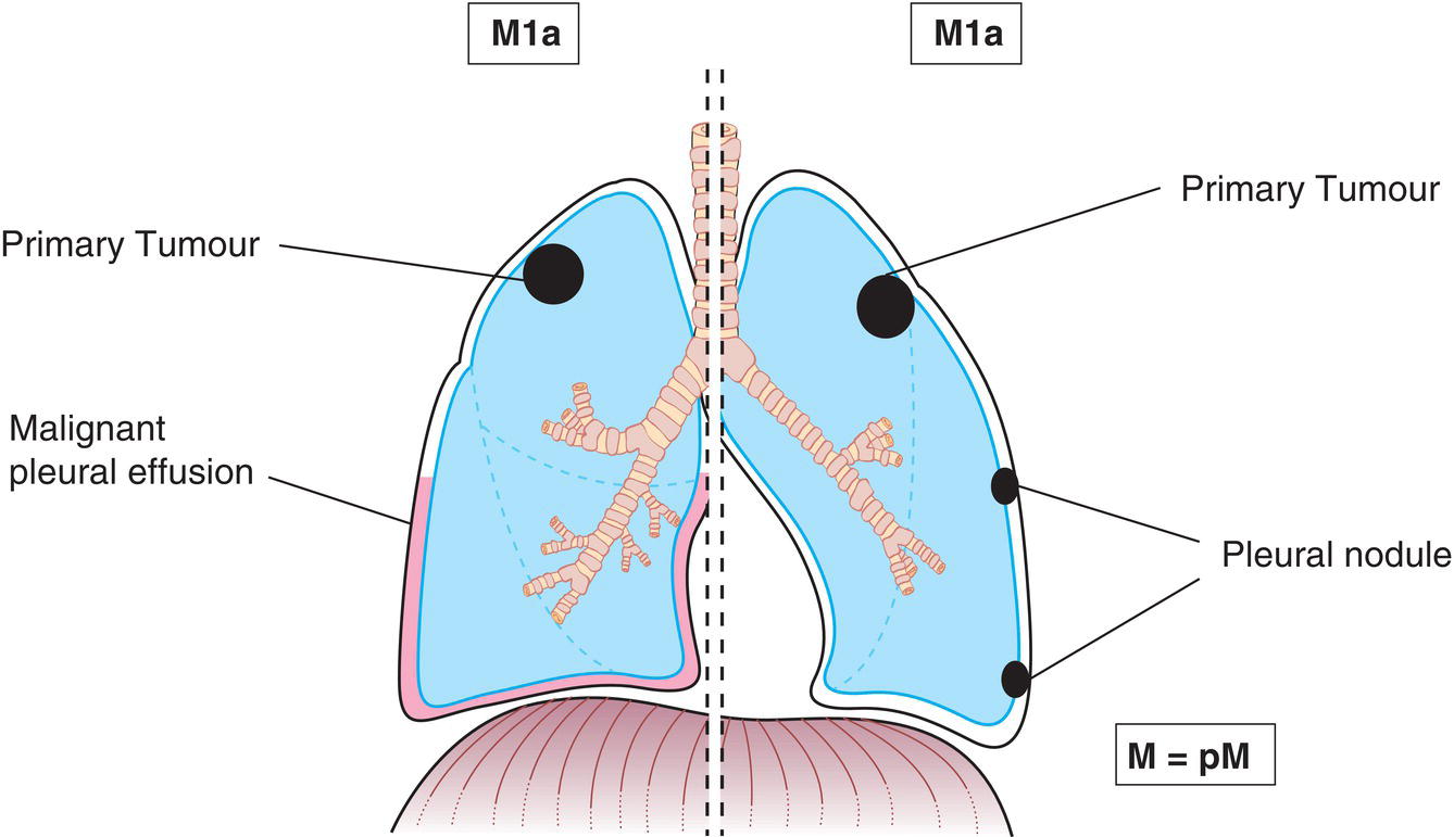 Schematic illustration of tumour with pleural or pericardial nodules or malignant pleural.