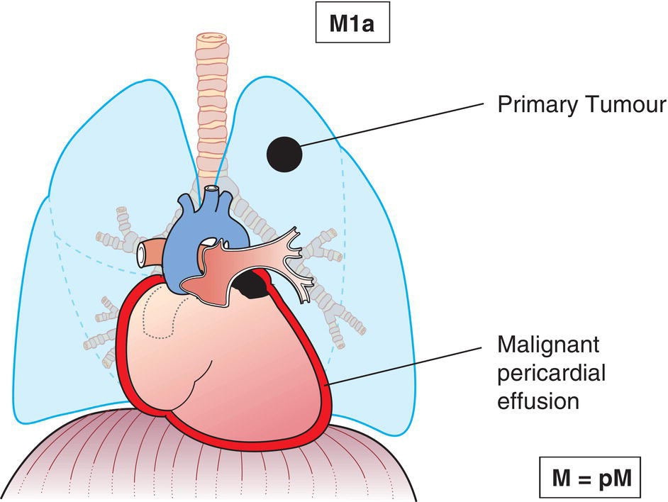 Schematic illustration of pericardial effusion.