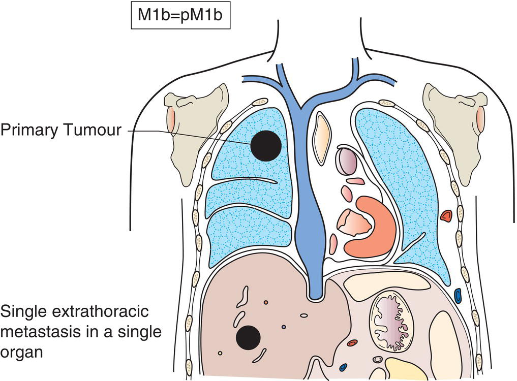 Schematic illustration of Single extrathoracic metastasis in a single organ.