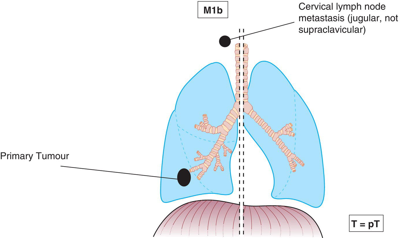 Schematic illustration of Single extrathoracic metastasis in a single organ.