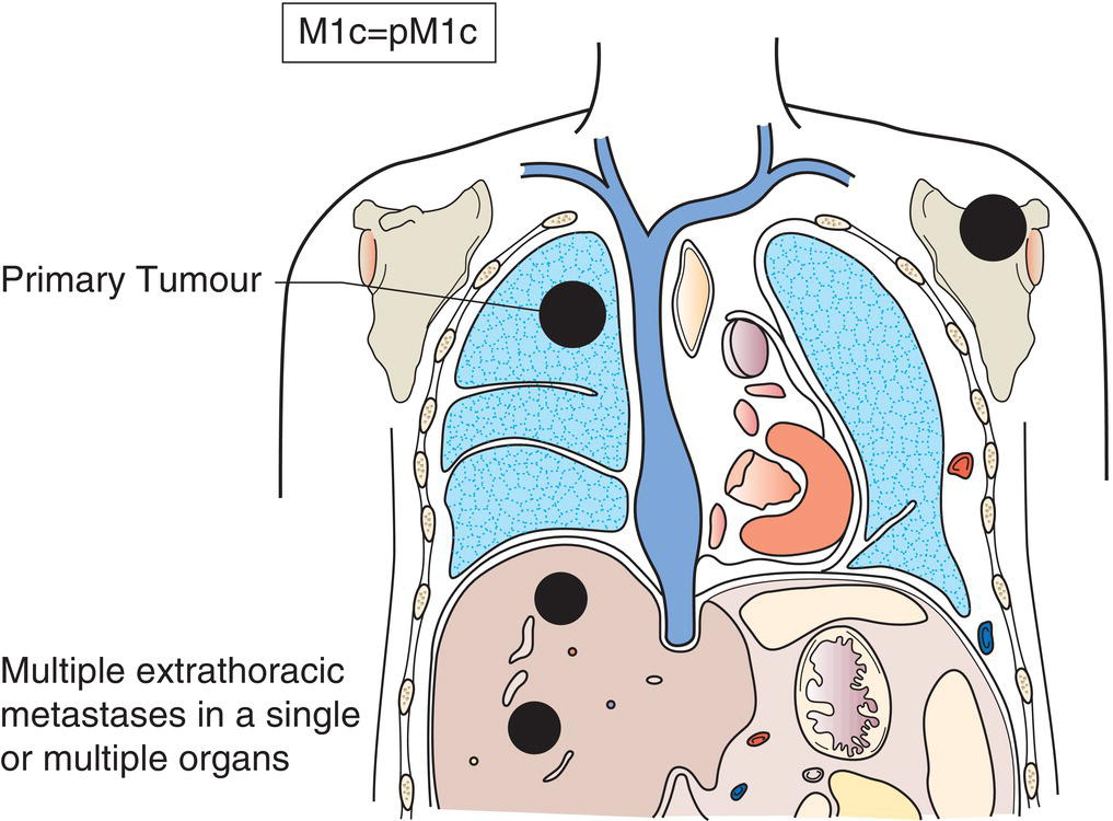 Schematic illustration of Multiple extrathoracic metastases in a single or multiple organ.