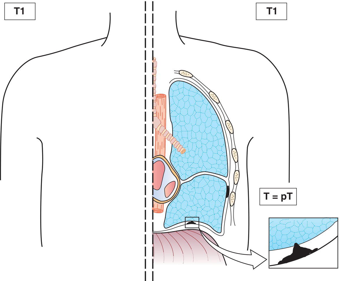 Schematic illustration of tumour involves ipsilateral parietal pleura only, with or without involvement of visceral, mediastinal or diaphragmatic pleura.