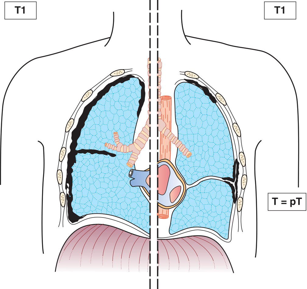 Schematic illustration of tumour involves ipsilateral parietal pleura only, with or without involvement of visceral, mediastinal or diaphragmatic pleura.