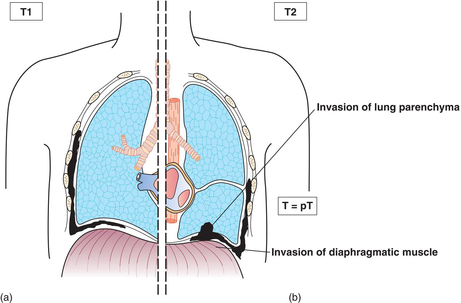 Schematic illustration of tumour involves the ipsilateral pleura with at least one the following: Invasion of diaphragmatic muscle and Invasion of lung parenchyma.