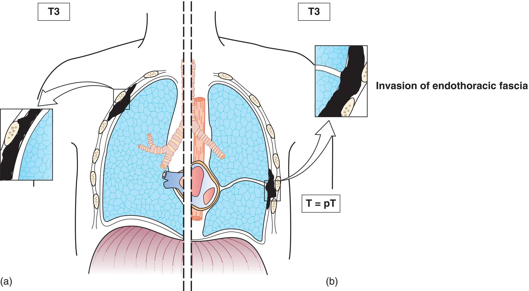 Schematic illustration of tumour involves ipsilateral pleura, with at least one of the following: Solitary focus of tumour invading soft tissues of the chest wall, Invasion of endothoracic fascia.