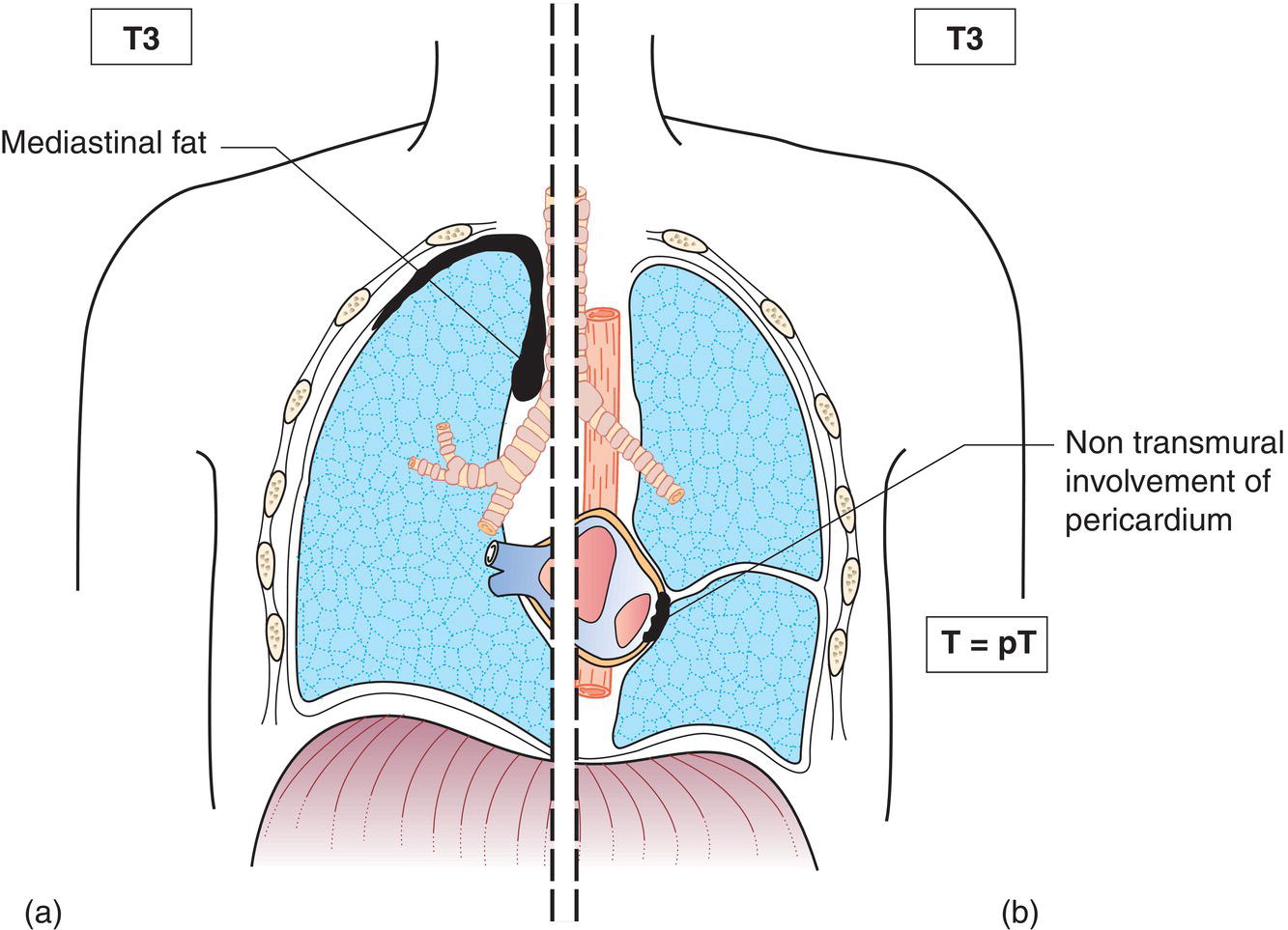 Schematic illustration of Non‐transmural involvement of the pericardium, Invasion into mediastinal fat.