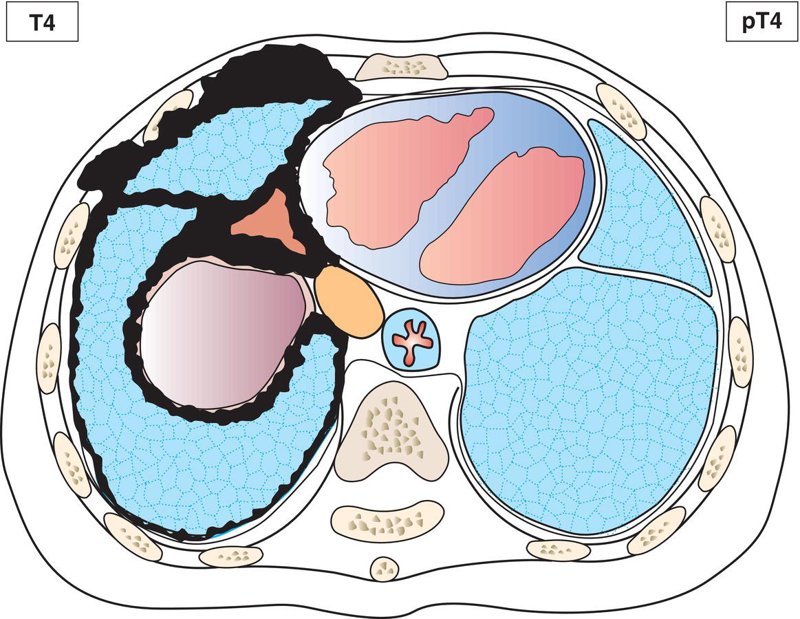 Schematic illustration of tumour involves ipsilateral pleura, with at least one of the following: Chest wall, with or without associated rib destruction.