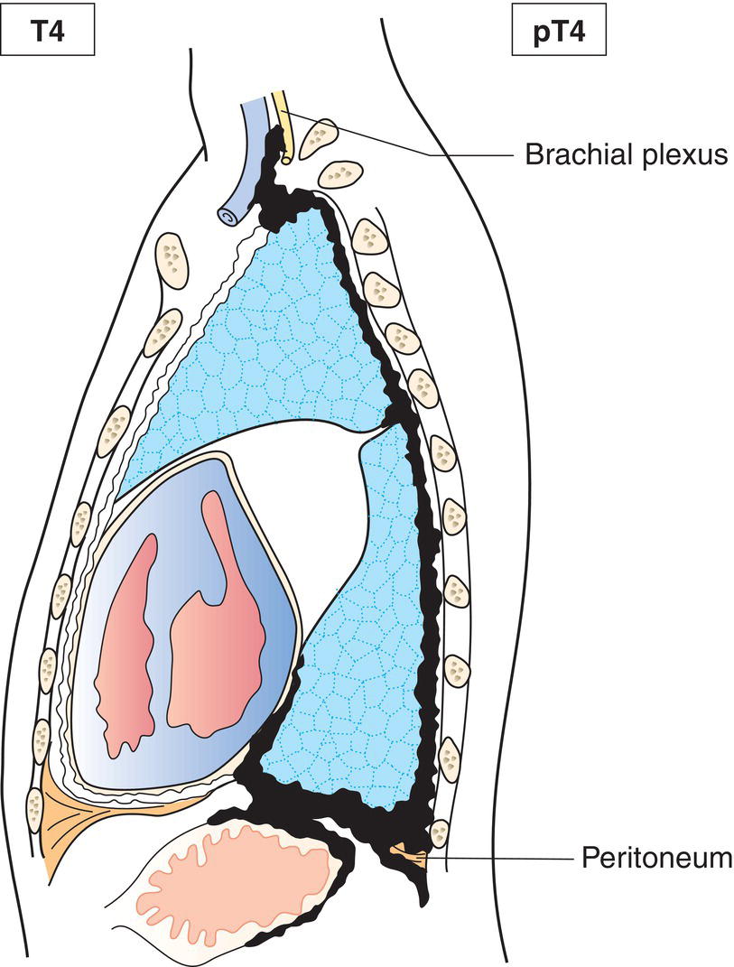 Schematic illustration of Peritoneum via direct transdiaphragmatic extension.