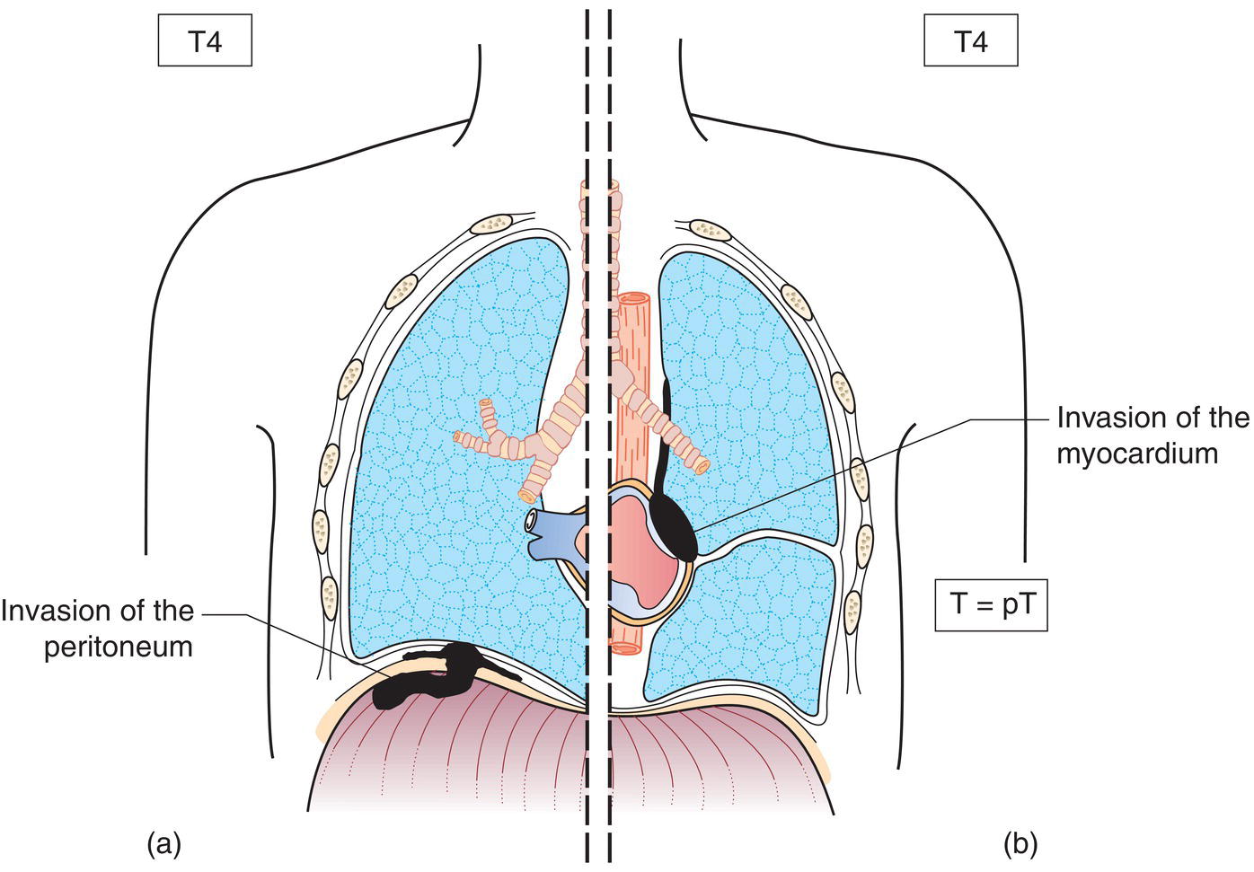 Schematic illustration of Mediastinal organs, Internal surface of the pericardium (transmural invasion with or without a pericardial effusion) or involvement of the myometrium.