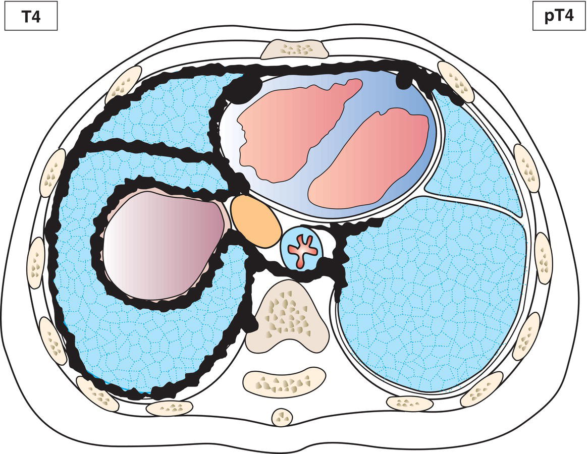 Schematic illustration of Contralateral pleura, Vertebra, neuroforamen, spinal cord, Internal surface of the pericardium or involvement of the myometrium.