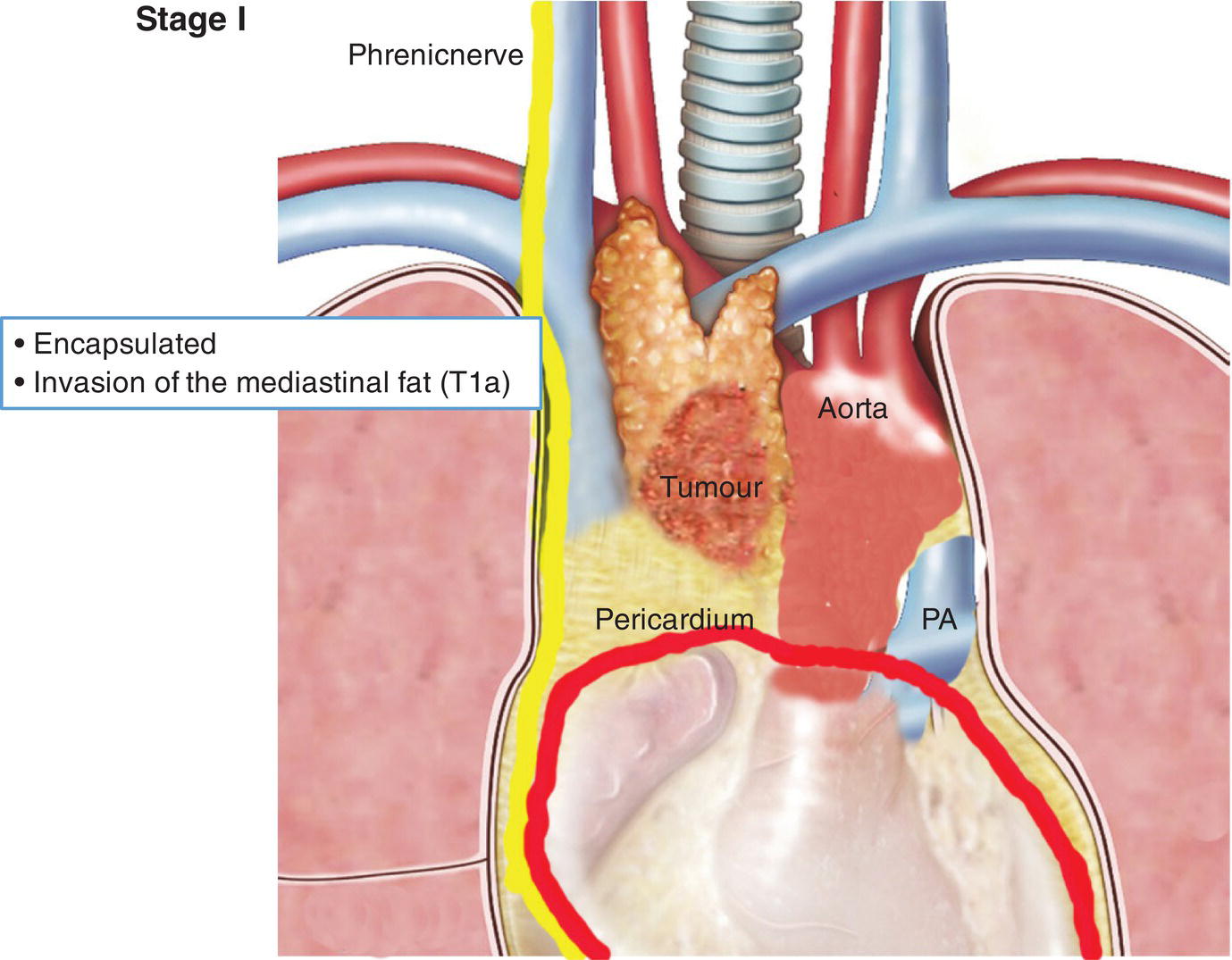 Schematic illustration of Invasion of the mediastinal fat.