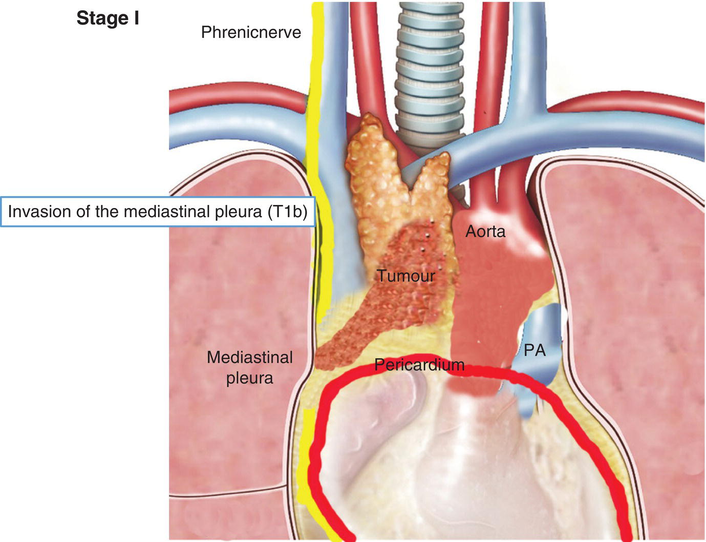 Schematic illustration of Invasion of the mediastinal pleura.