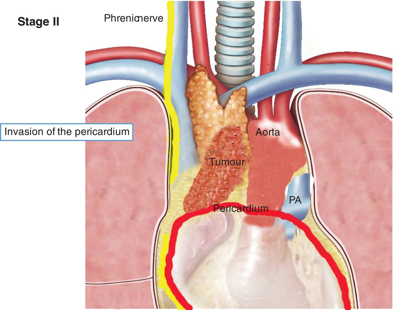 Schematic illustration of Invasion of the pericardium.