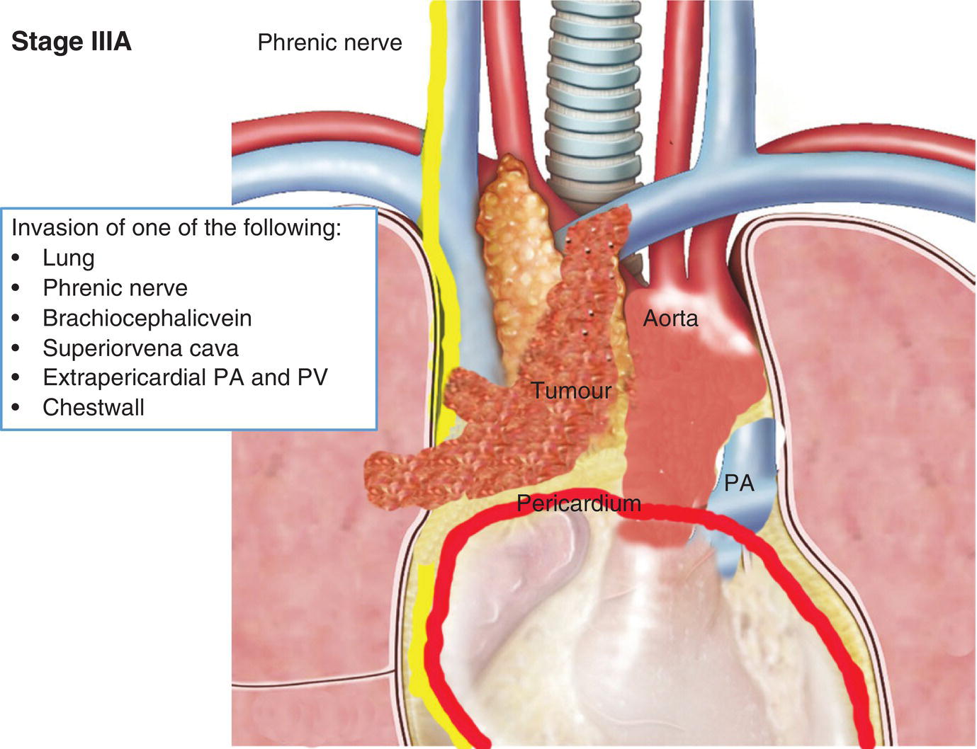 Schematic illustration of Invasion of one of the following: Lung, Phrenic nerve, Brachiocephalicvein, Superiorvena cava, Extrapericardial PA and PV, Chestwall.