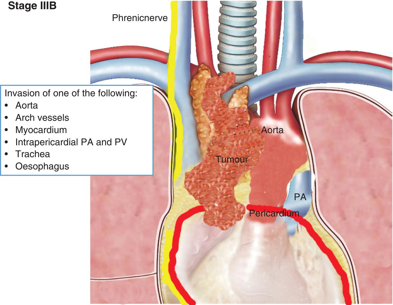 Schematic illustration of Invasion of one of the following: Aorta, Arch vessels, Myocardium, Intrapericardial PA and PV, Trachea, Oesophagus.