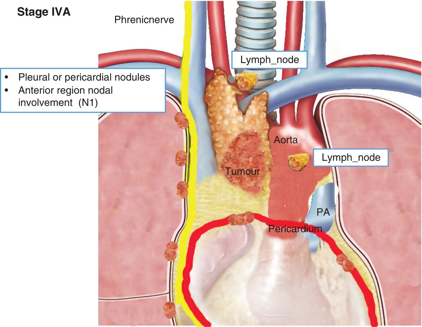 Schematic illustration of Anterior region nodal
involvement (N1), Pleural or pericardial nodules.