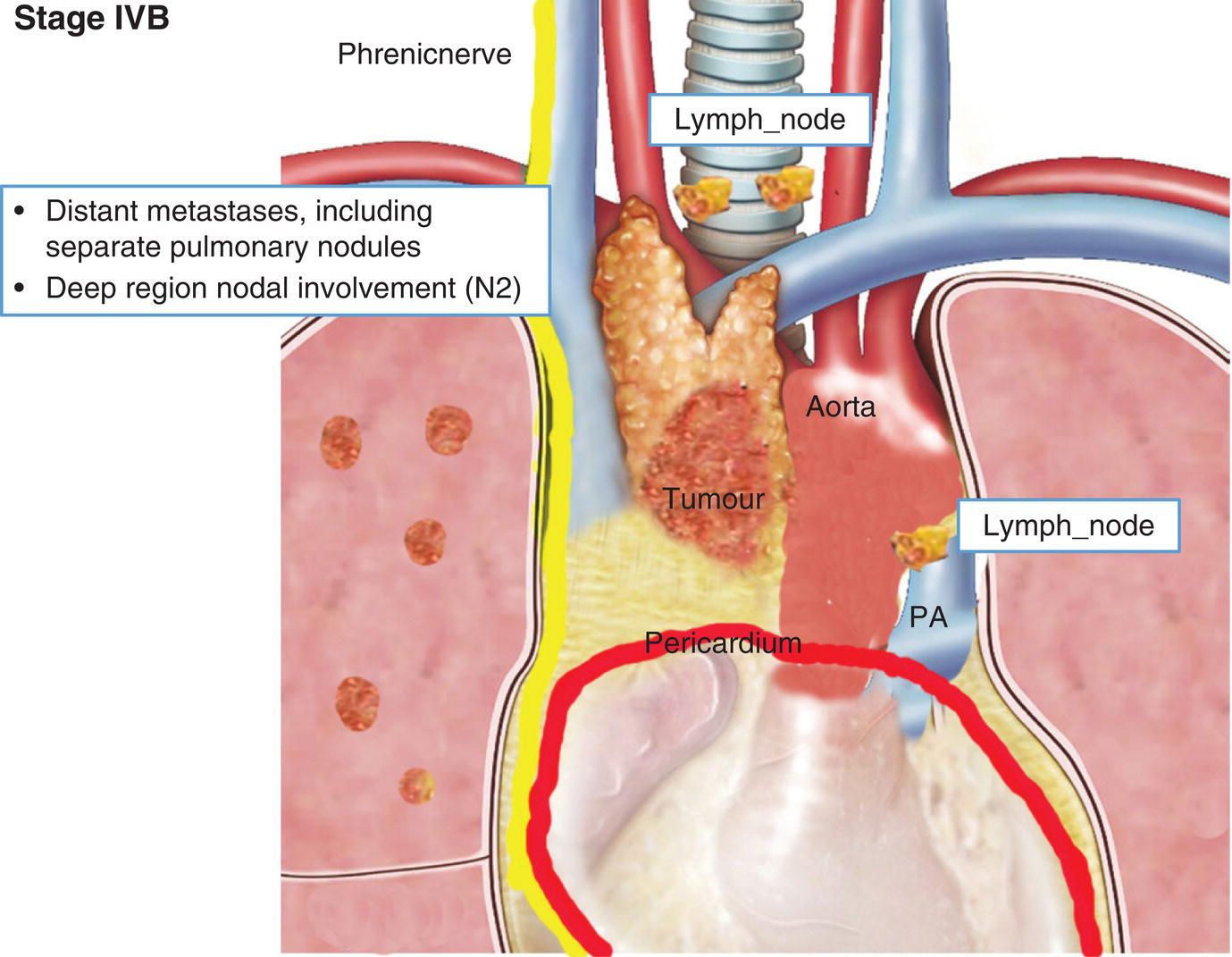 Schematic illustration of Distant metastases, including
separate pulmonary nodules, Deep region nodal involvement (N2).