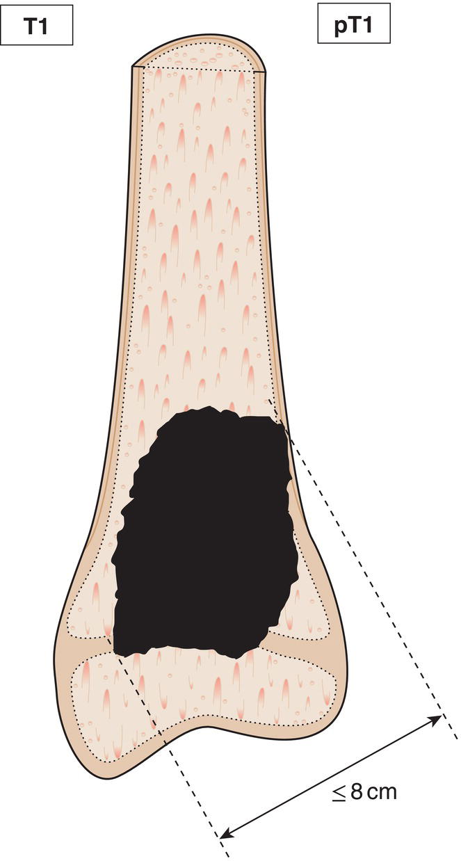 Schematic illustration of tumour 8 cm or less in greatest dimension.