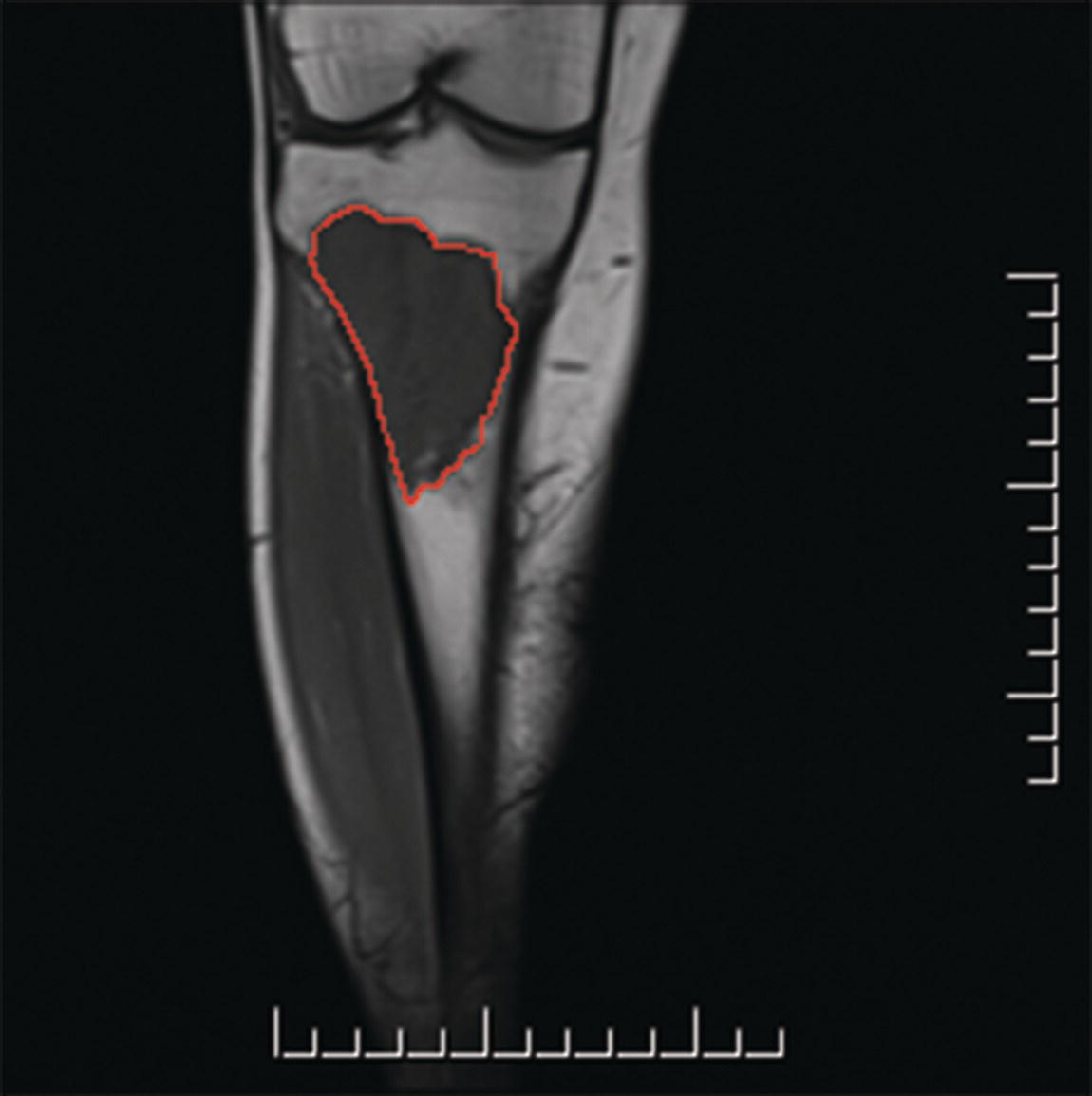 Photo depicts a T1 sarcoma of the tibia 8 cm in greatest dimension.