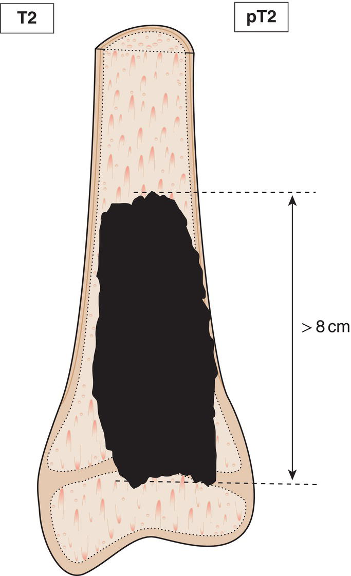 Schematic illustration of tumour more than 8 cm in greatest dimension.