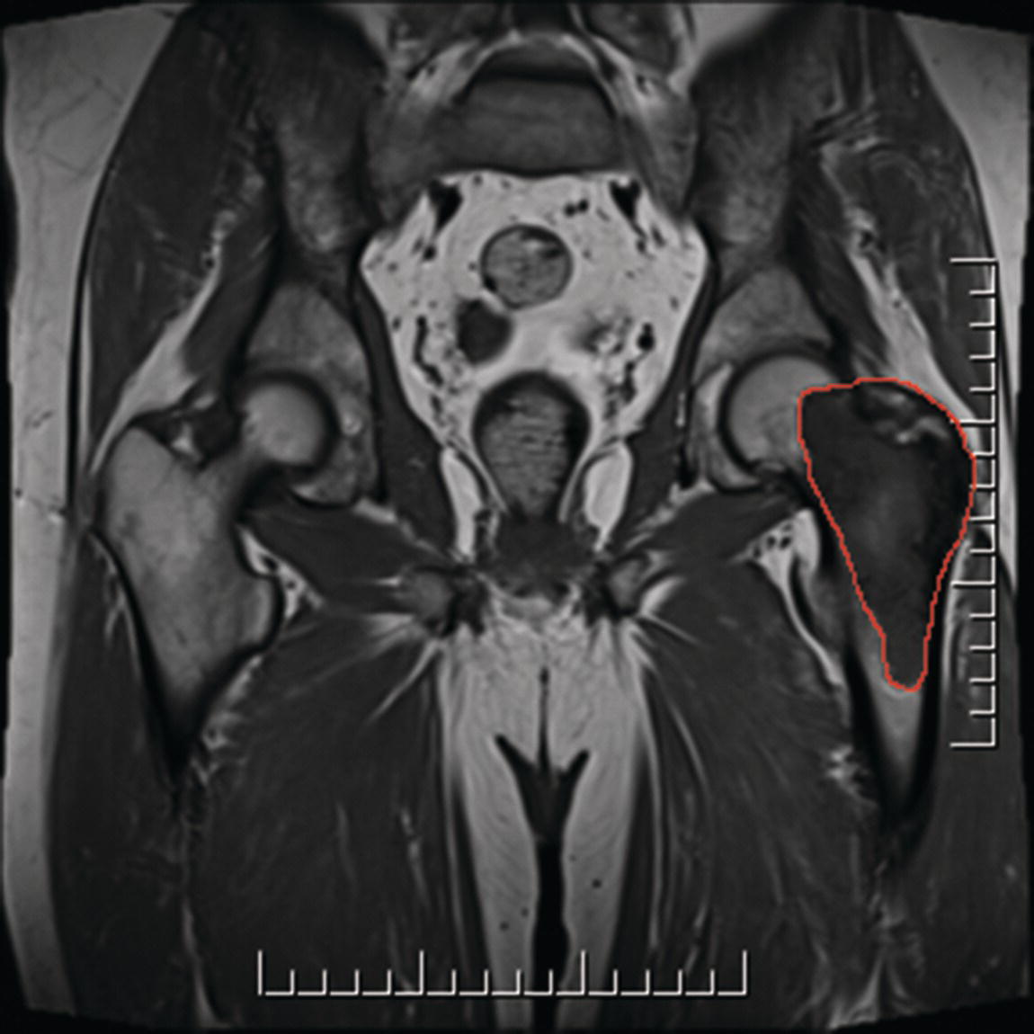 Photo depicts a T2 sarcoma of the femur more than 8 cm in greatest dimension.