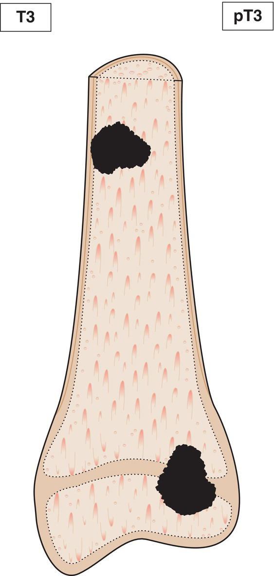 Schematic illustration of Discontinuous tumours in the primary bone site.