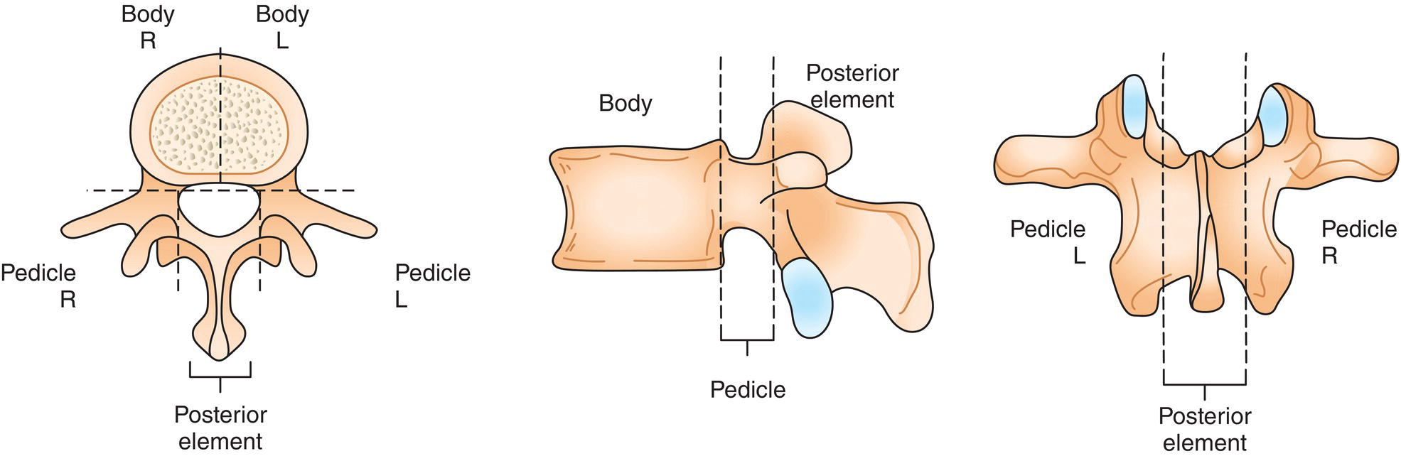 Schematic illustration of the five vertebral segments Right pedicle, Right body, Left body, Left pedicle, Posterior element.