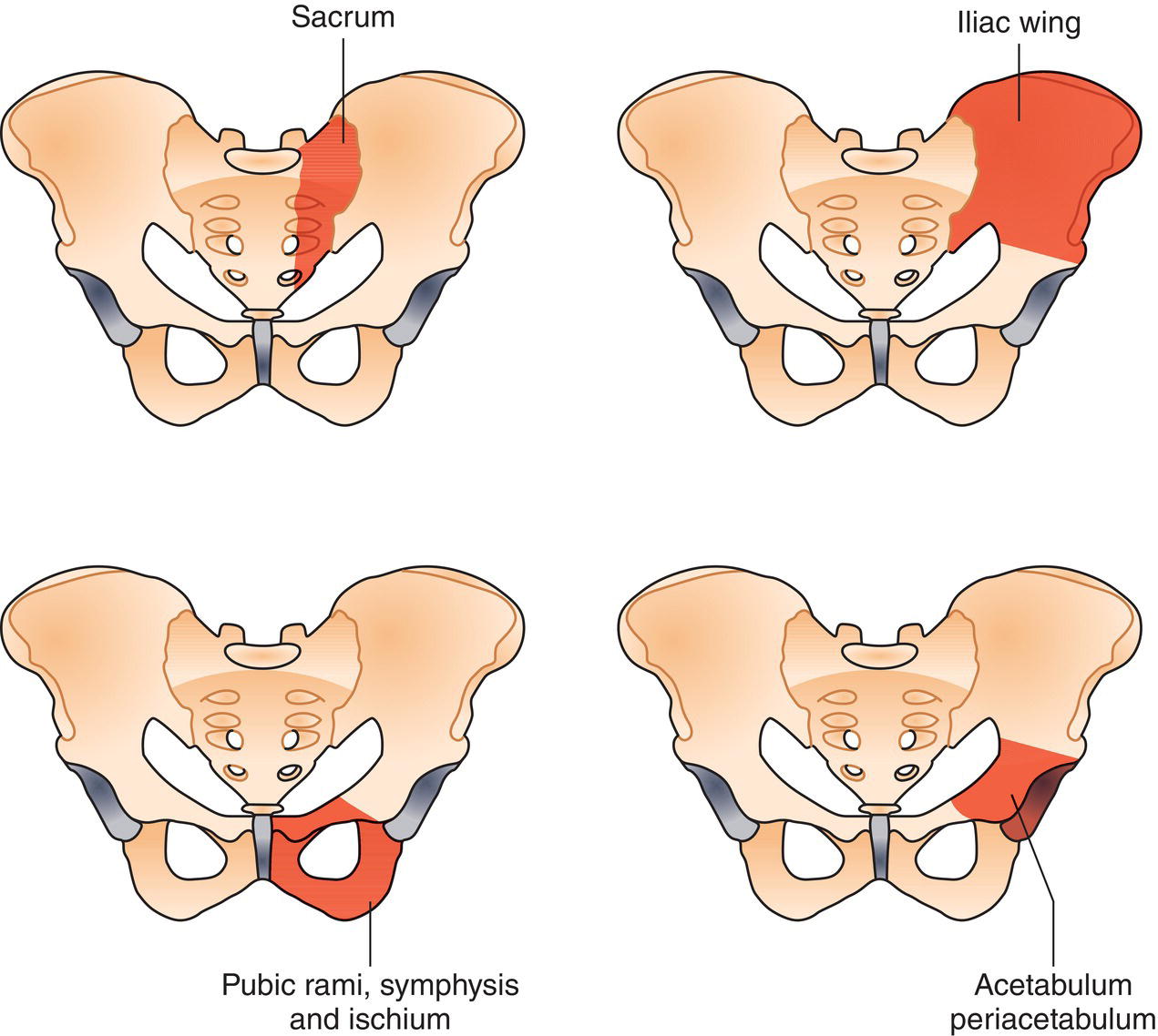 Schematic illustration of The four pelvic segments are: Sacrum lateral to sacral foramen, Iliac wing, Acetabulum/periacetabulum, Pelvic rami, symphysis and ischium.