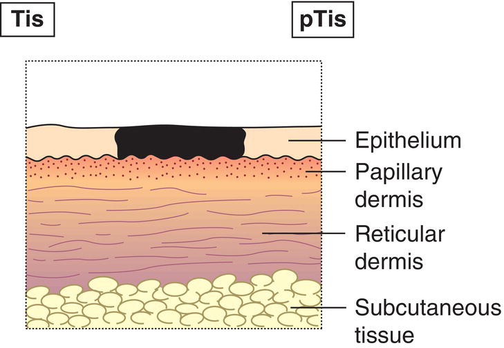 Schematic illustration of Carcinoma in situ.