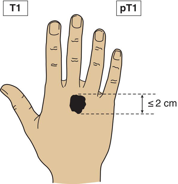 Schematic illustration of tumour 2 cm or less in greatest dimension.