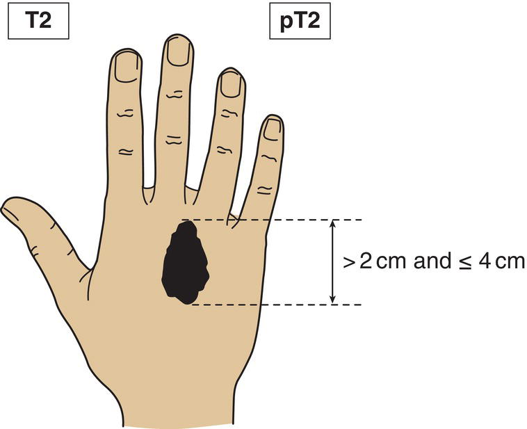 Schematic illustration of tumour greater than 2 cm and less than or equal to 4 cm in greatest dimension.