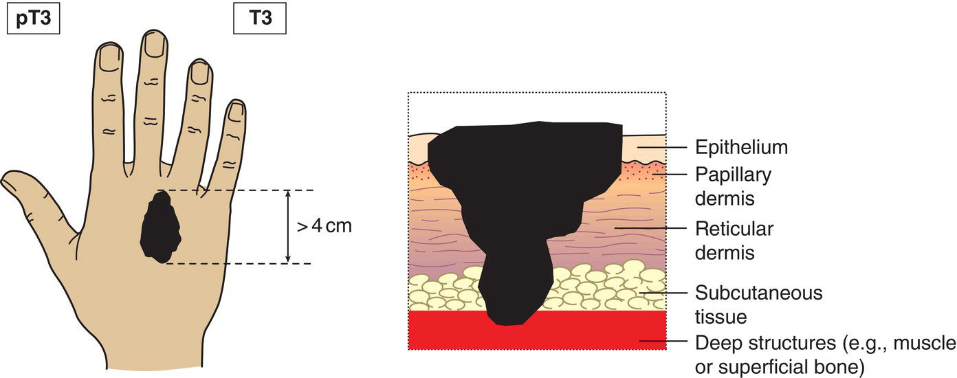 Schematic illustration of tumour greater than 4 cm in maximum dimension or minor bone erosion or perineural invasion or deep invasion.