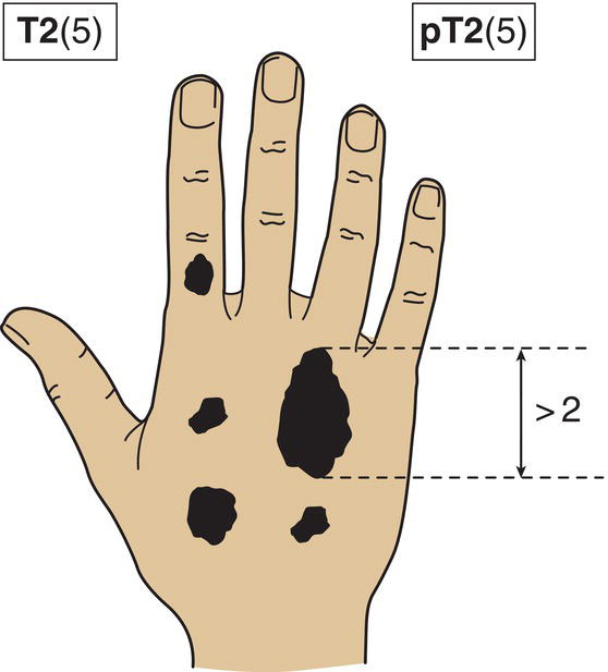 Schematic illustration of tumour with the highest T category is classified and the number of separate tumours is indicated in parentheses.