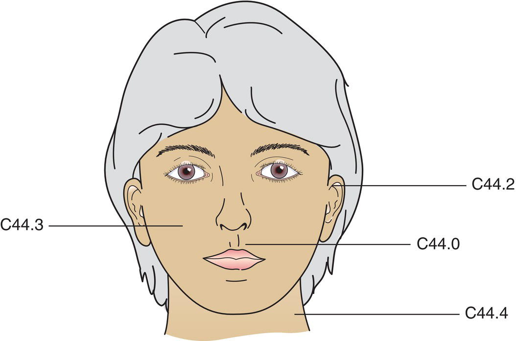 Schematic illustration of ICD-O topography rubrics, Lip, External ear, Other and unspecified parts of face, Scalp and neck.