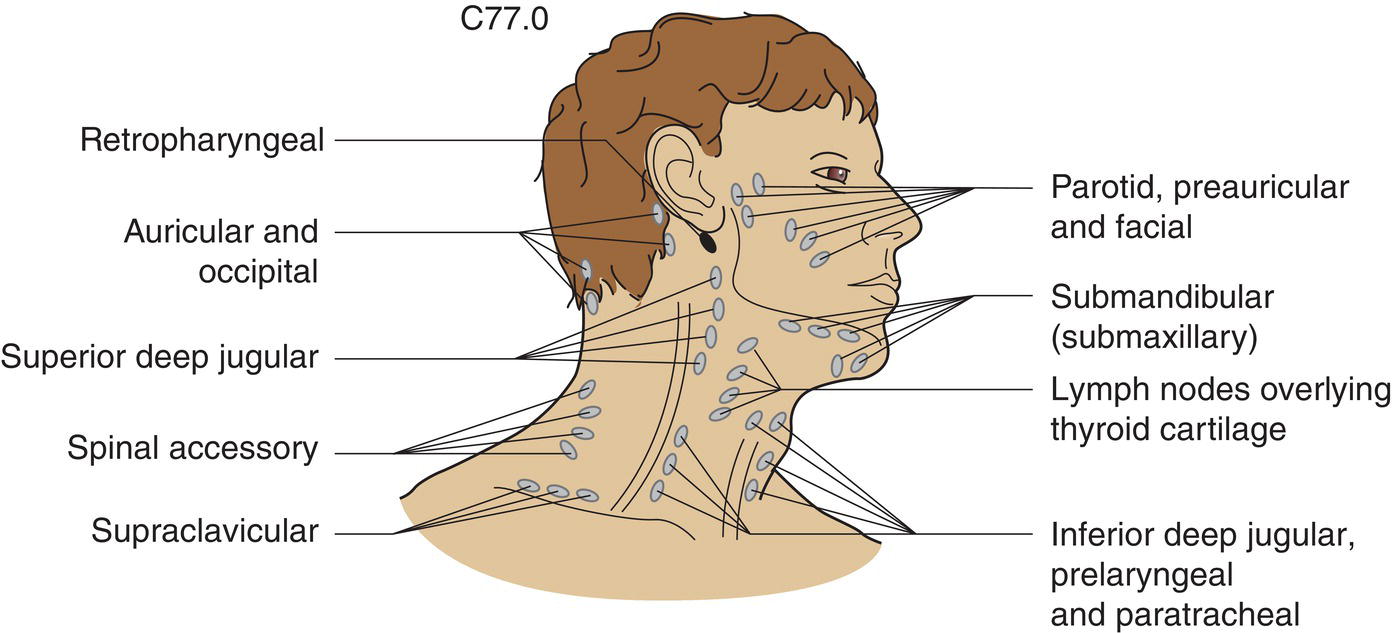 Schematic illustration of The regional lymph nodes are Ipsilateral preauricular, submandibular, cervical and supraclavicular lymph nodes.