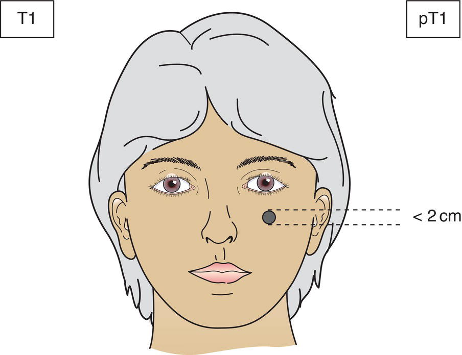 Schematic illustration of Tumor 2 cm or less in greatest dimension.