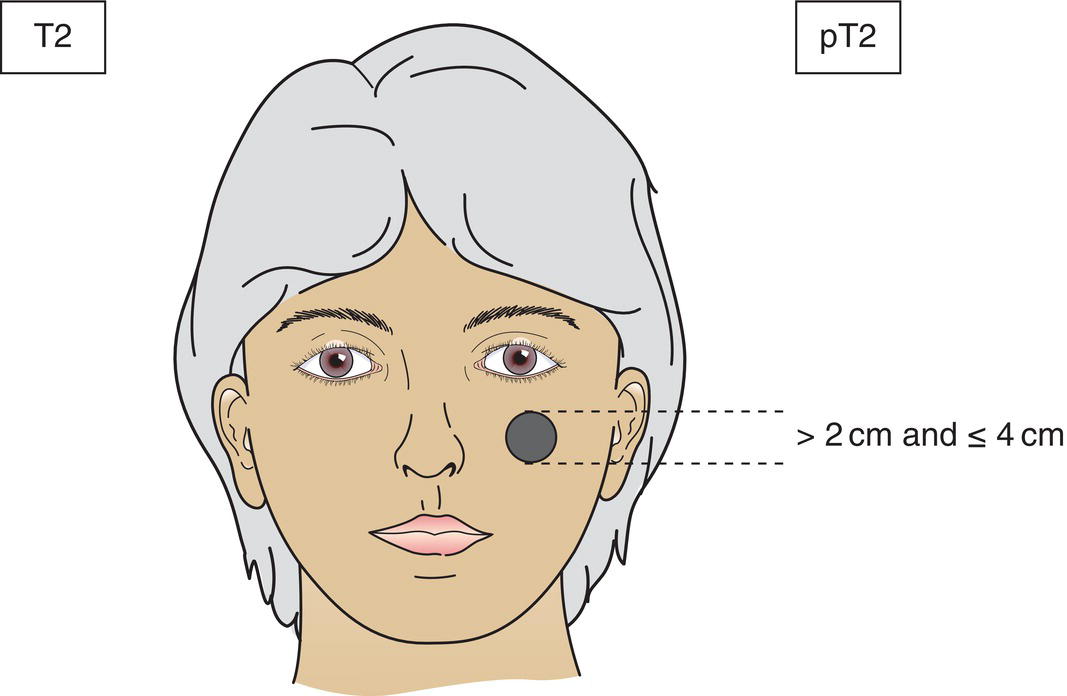 Schematic illustration of Tumor greater than or equal to 2 cm and less than or equal to 4 cm in greatest dimension.