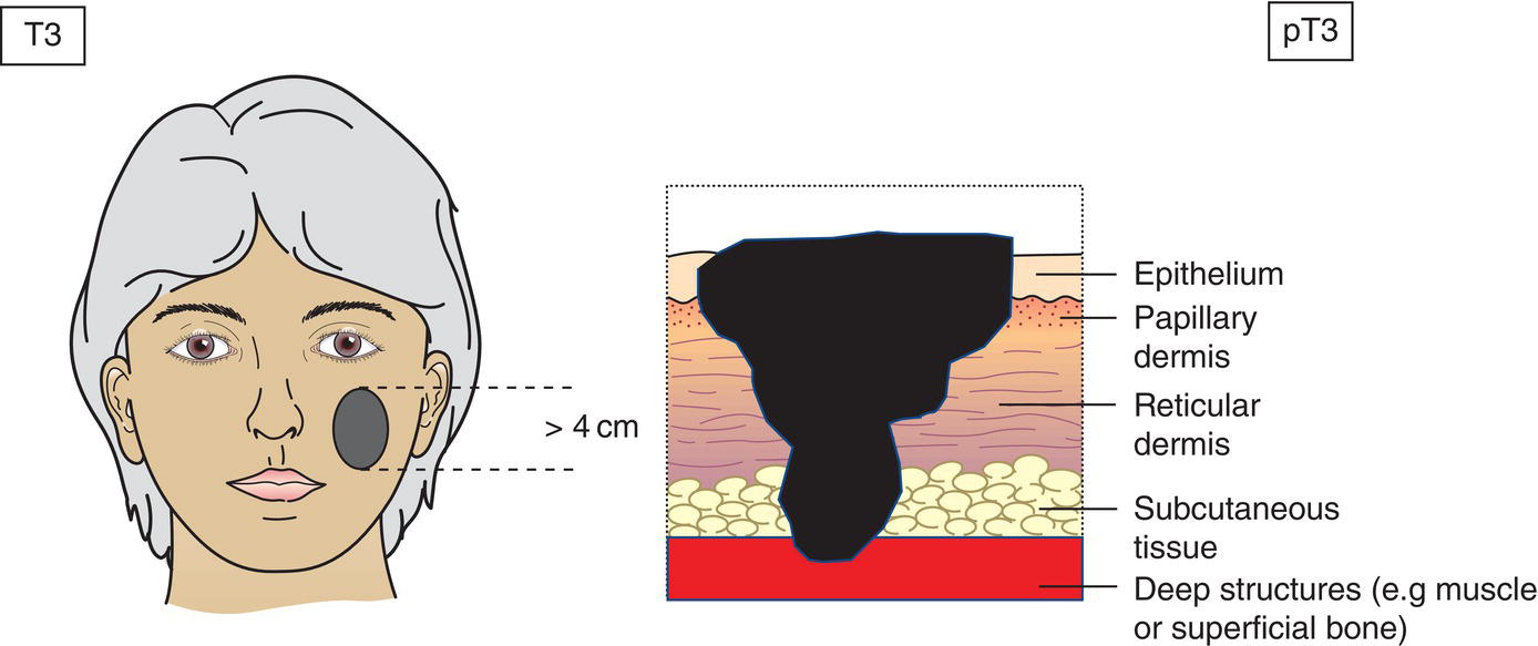 Schematic illustration of Tumor greater than or equal to 4 cm in maximum dimension or minor bone erosion or perineural invasion or deep invasion.