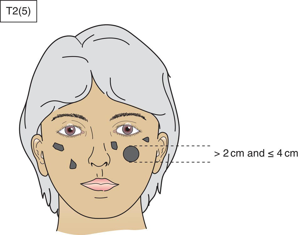 Schematic illustration of the tumour with the highest T category is classified and the number of separate tumours is indicated in parentheses.